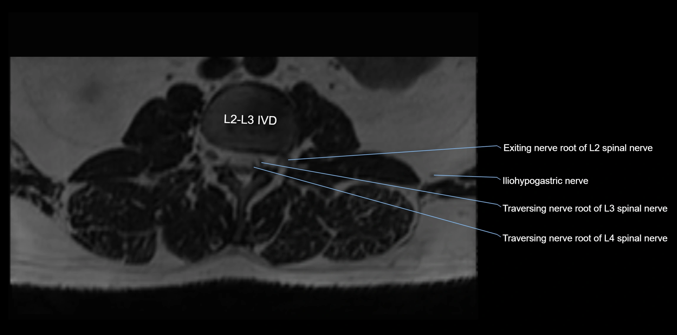 MR lumbosacral plexus axial cross sectional anatomy 3T  radiology  image-img-1008001-00008.webp
